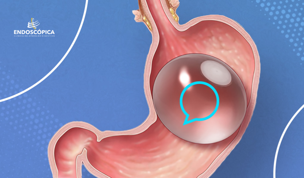 Balão Intragástrico: O que é? Qual o procedimento?