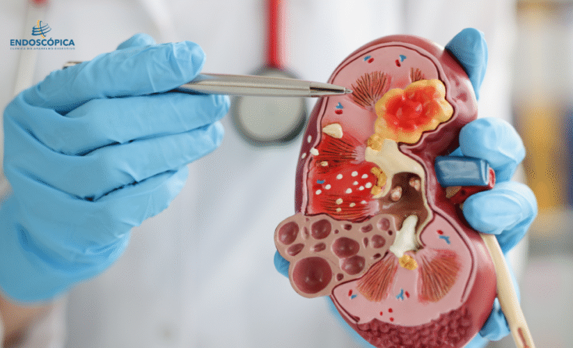 CÁLCULOS RENAIS – COMO SE FORMAM, PRINCIPAIS CAUSAS, SINTOMAS E TRATAMENTO