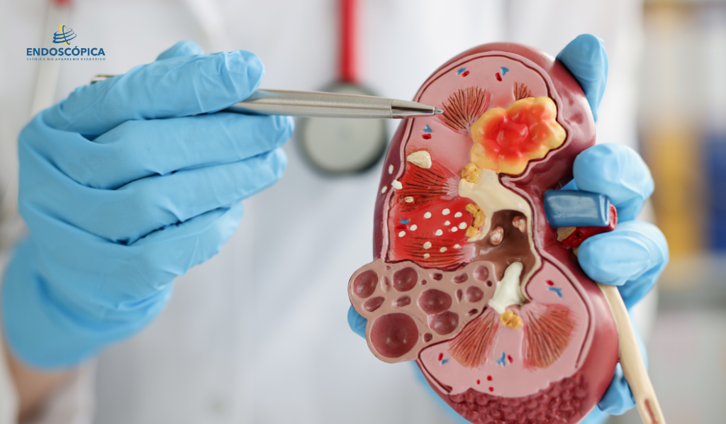 CÁLCULOS RENAIS – COMO SE FORMAM, PRINCIPAIS CAUSAS, SINTOMAS E TRATAMENTO