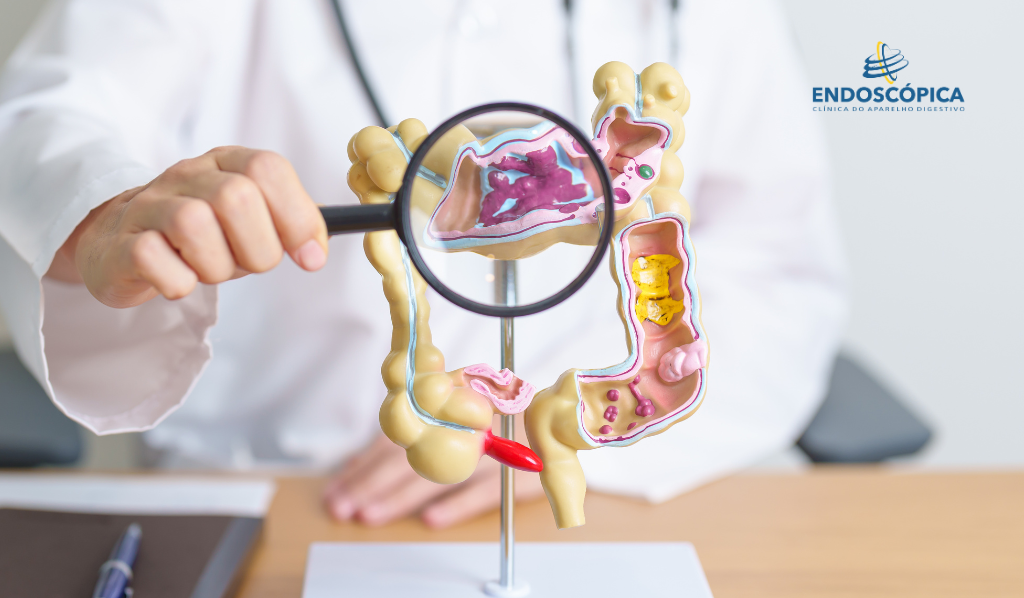 Câncer de Intestino: O 3º câncer mais frequente no Brasil